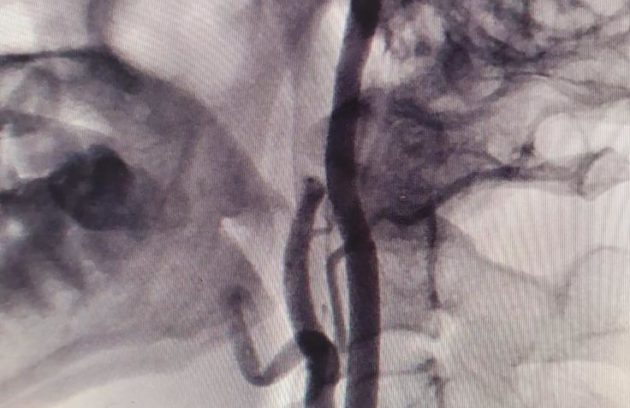 Post Angioplasty and Stenting