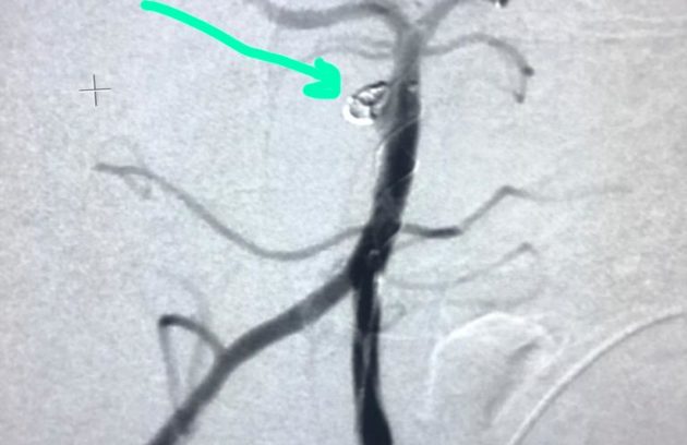 Post Stent Assisted Coiling