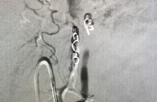 Post Coil Embolization of Left Gastric artery - Complete Occlusion