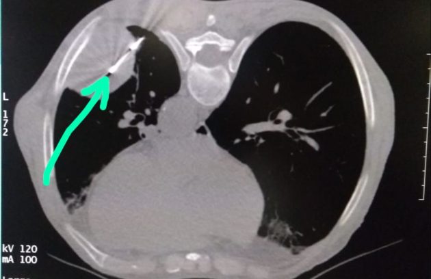 CT guides lung biopsy