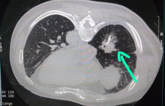 CT guided lung biopsy