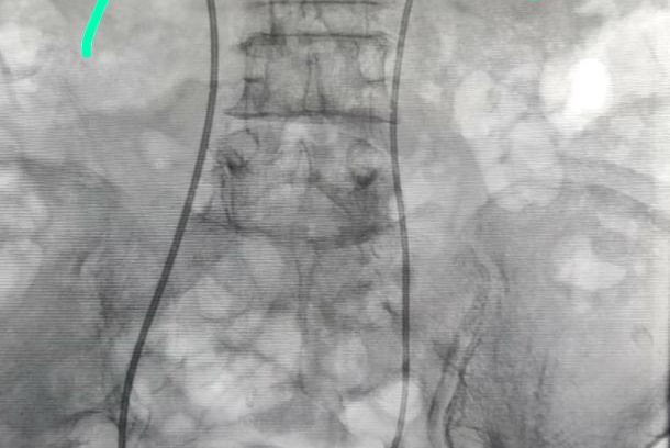 Rt. PCN and Bilateral DJ stent exchange
