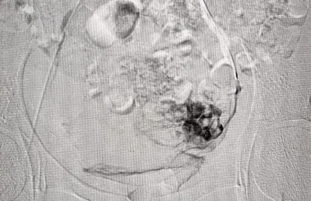 Uterine artery embolization for fibroid